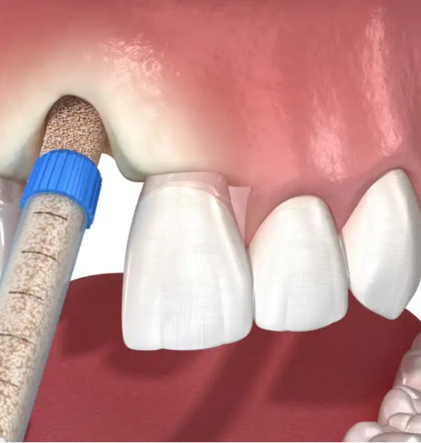 Xcem Osspore Bovine Bone + Beta-TCP Mix Graft