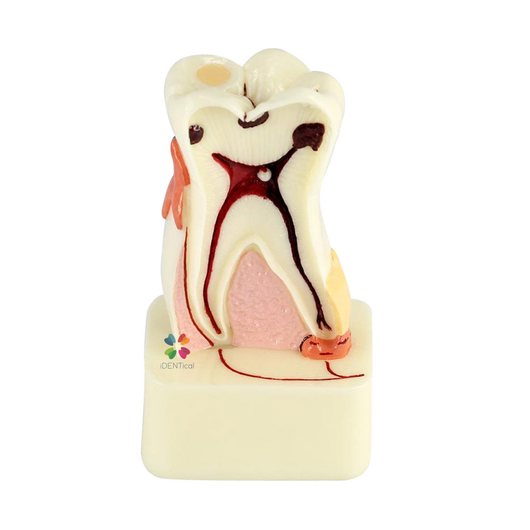 iDENTical 4X Pathologies Of Tooth Model - M4015