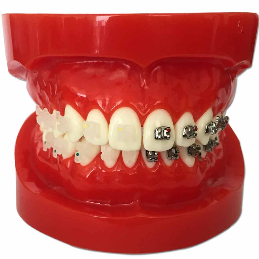 iDENTical Half Metal And Half Ceramic Brackets Orthodontics Model - M3003 (Red)