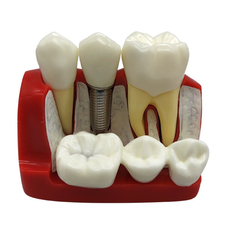 iDENTical Implant Analysis Model - M2017