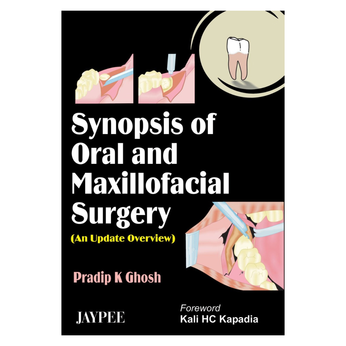Jaypee Medical Synopsis Of Oral And Maxillofacial Surgery: An Update Overview (ISBN - 616371)