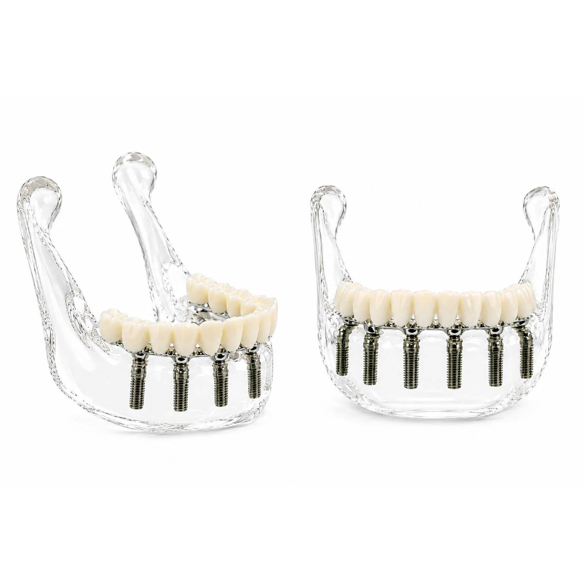 Julldent Lower Jaw Implant Model (JULL-DENT 208)