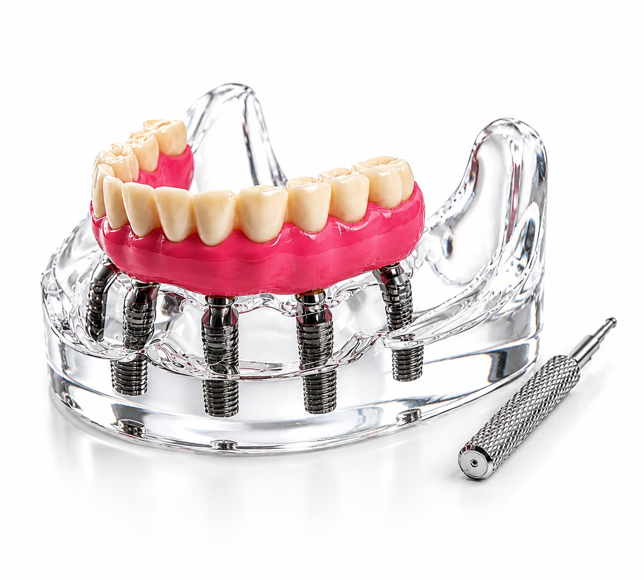 Julldent Overdenture Implant Model with 6 Implants (JULL-DENT 202)