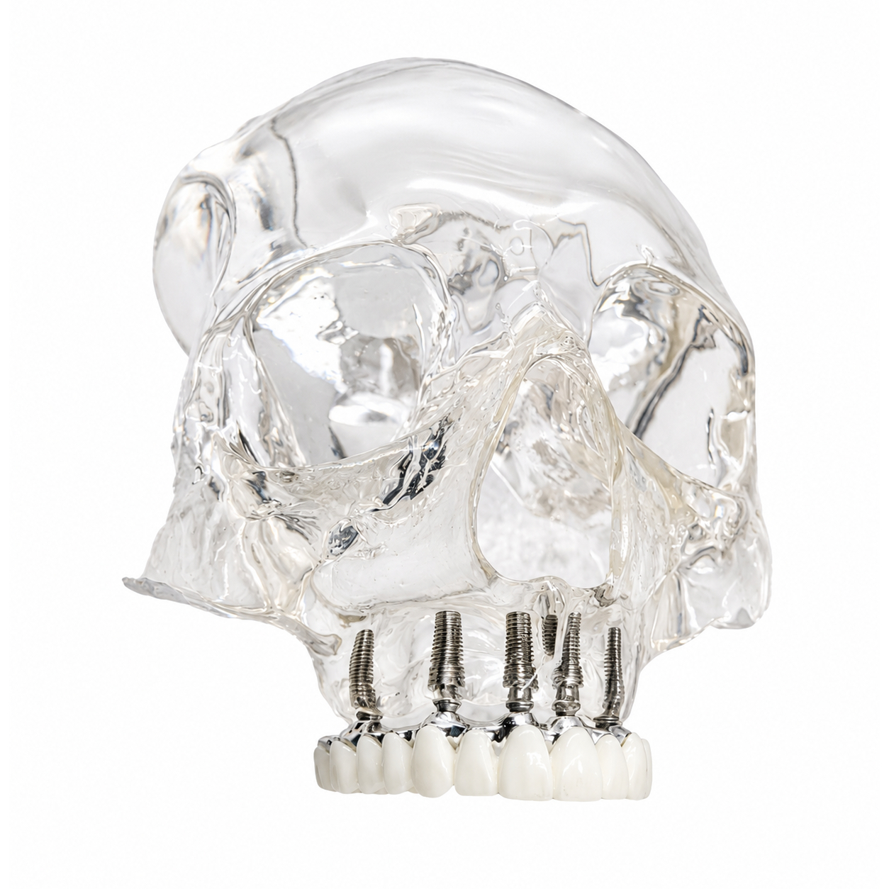 Julldent Skull Implant Model (JULL-DENT 209)