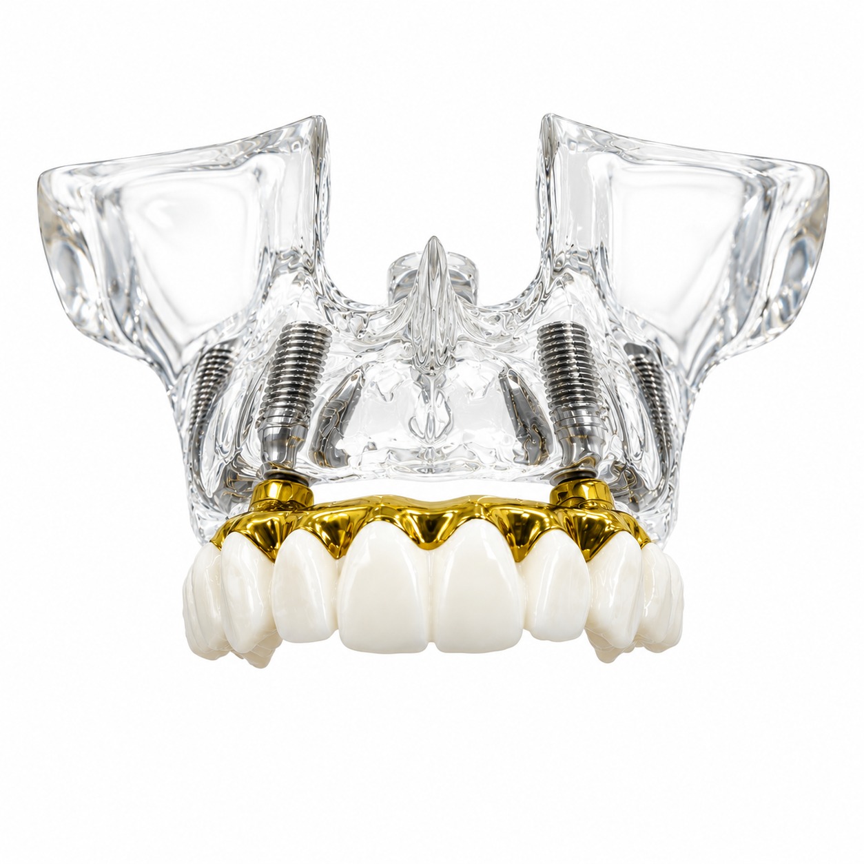 Julldent Upper Jaw Implant Model (JULL-DENT 205)