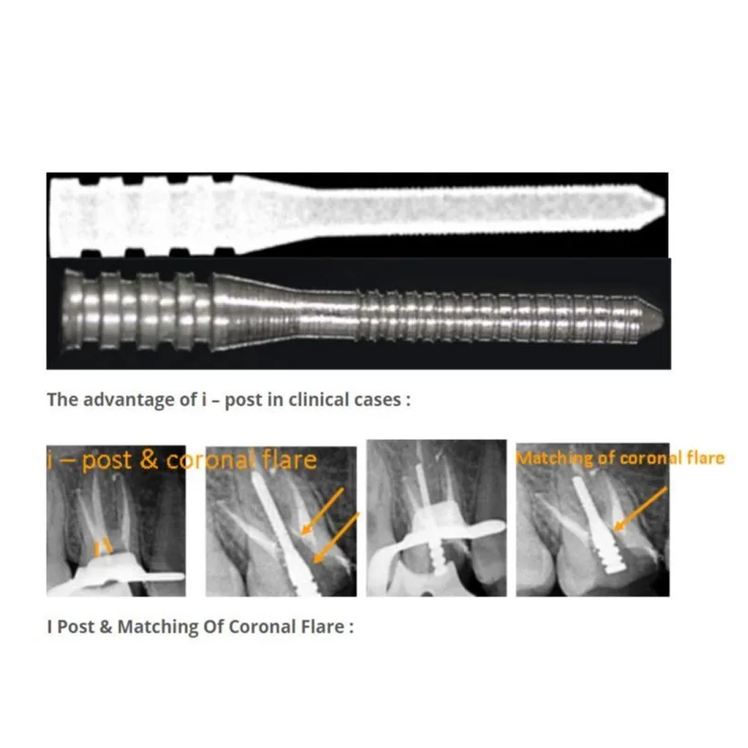 Prime Dental iPost (Endo Metal Post) - Integrated Endodontics #5